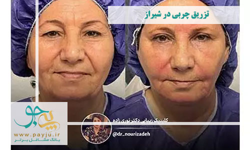 تزریق چربی در شهر شیراز