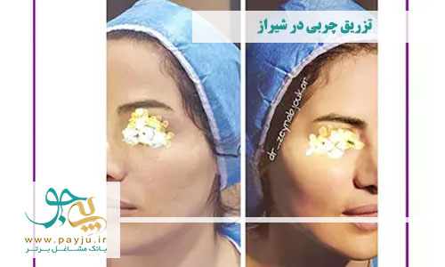 تزریق چربی صورت در شهر شیراز