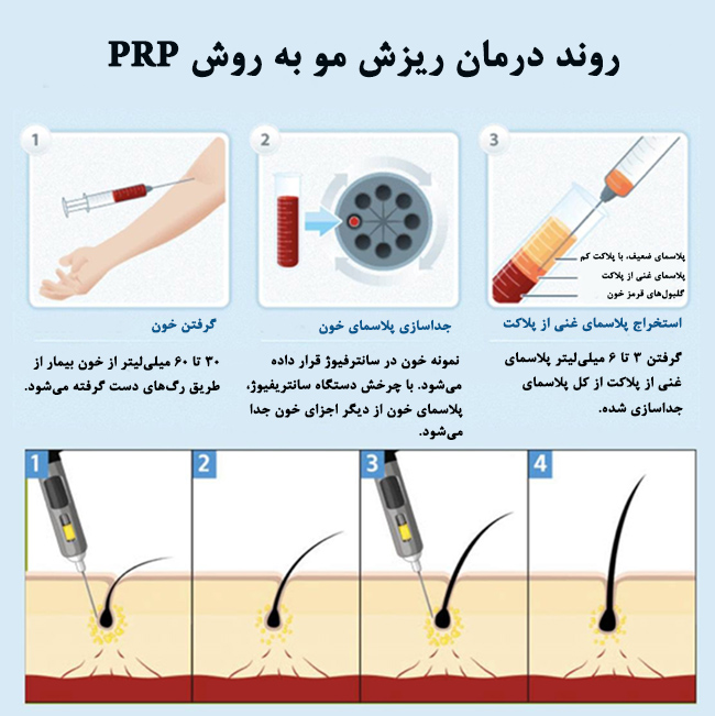 درمان ریزش مو با روش پی آر پی (PRP)
