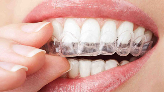 با چه روشی های میتوان دندان های را سفید کرد