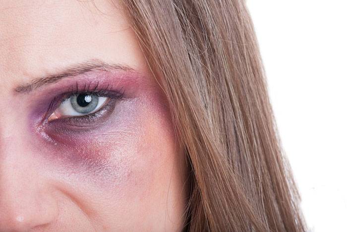 درمان خانگی خون مردگی و کبودی زیر چشم در اثر ضربه