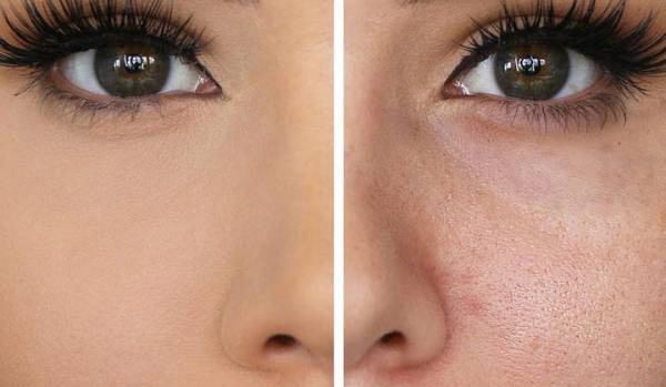 میکرونیدلینگ روشی موثر برای درمان منافذ باز پوست